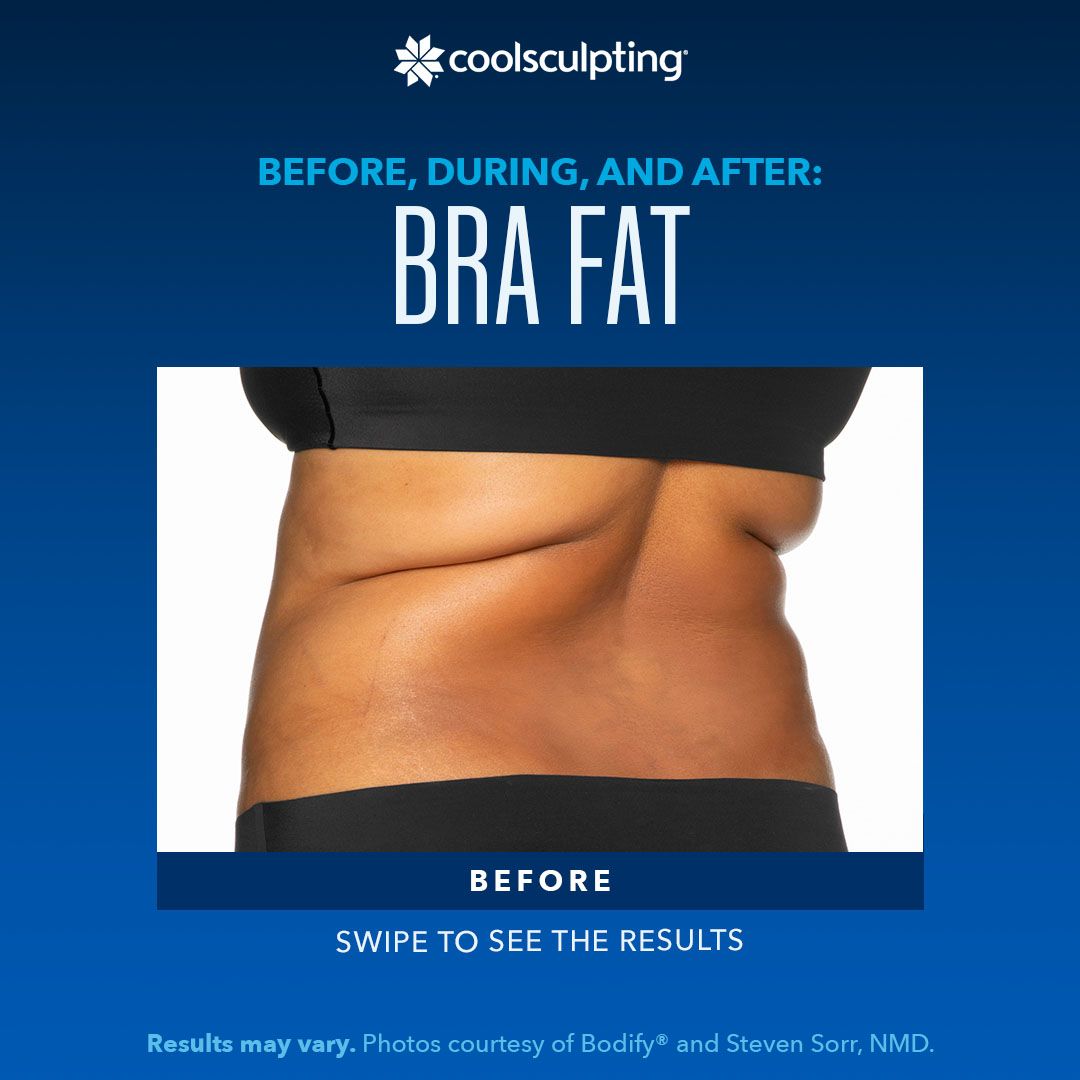 a woman's torso with bra fat is shown before a coolsculpting treatment