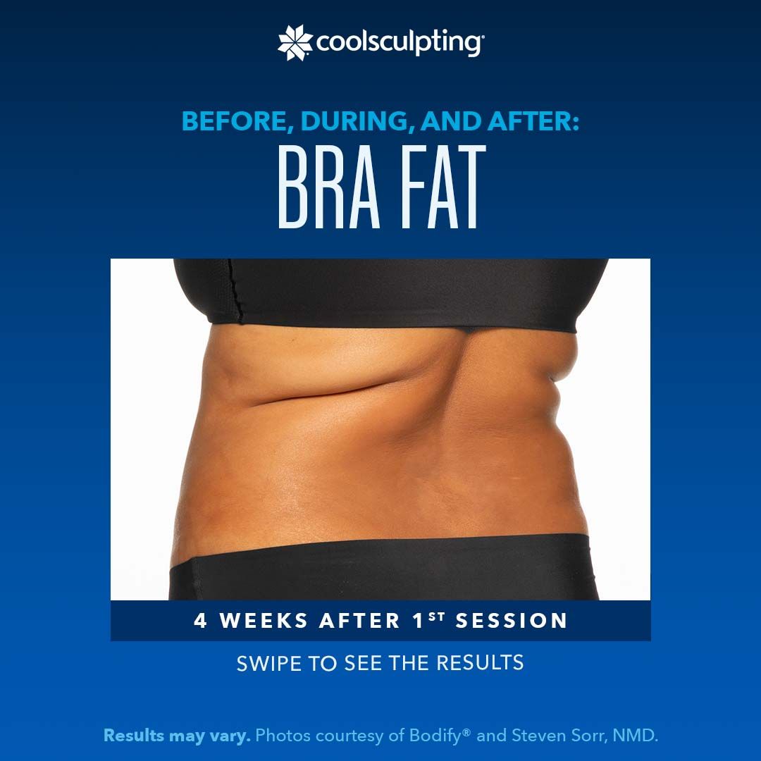 a woman's torso with bra fat is shown in the middle of her  coolsculpting treatment