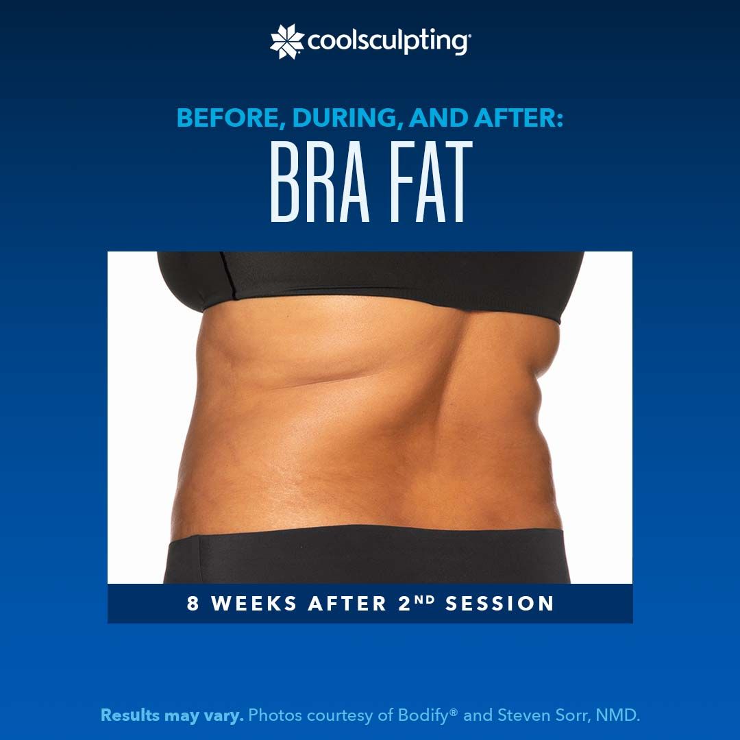a woman's torso with now minimal bra fat is shown after a coolsculpting treatment