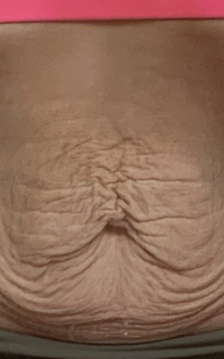 a close up of a woman 's stomach with wrinkles