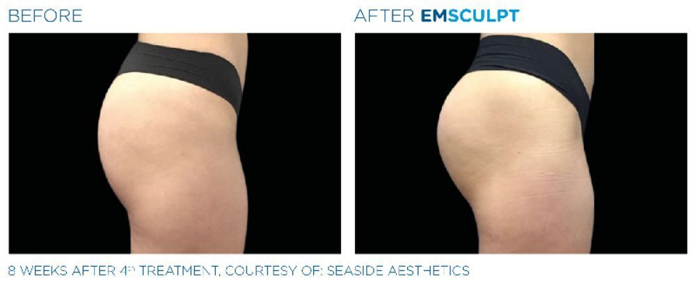 a picture of a woman's buttock before and after Emsculpt treatment