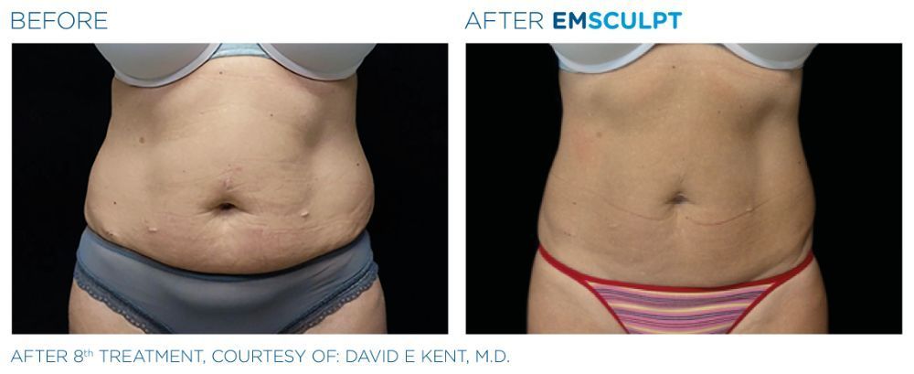 photos of a woman's torso before on the left and after on the right after Emscumpt treatment
