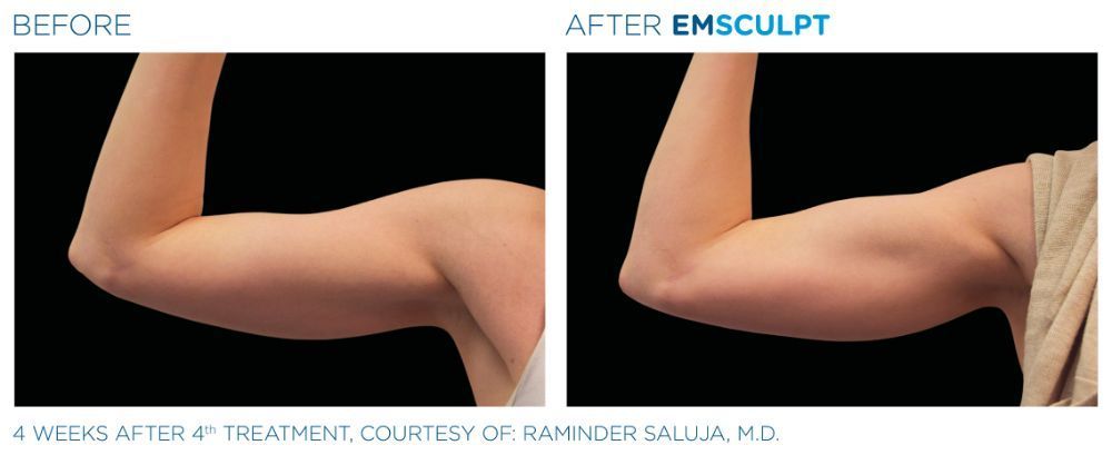 a picture of a man's upper arm before and after Emsculpt treatment