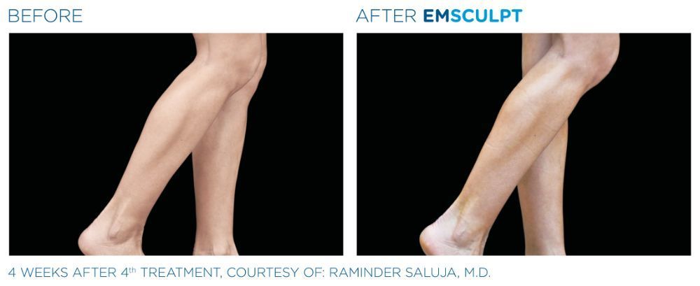 a picture of a woman's legs before and after Emsculpt treatment