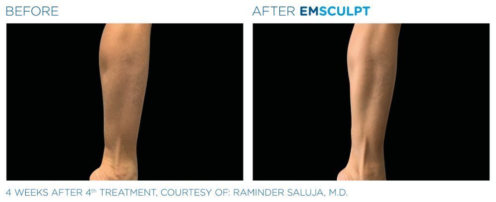 a picture of a man's calf before and after Emsculpt treatment