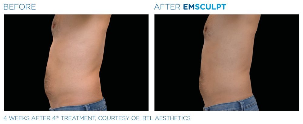 photos of a man's torso. before on the left and after on the right after Emscumpt treatment. his abs are now more defined.