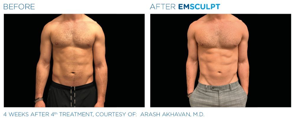 a picture of a man's torso before left and after Emsculpt treatment on right. his abs are now much more defined
