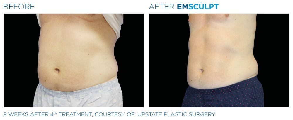 a picture of a man's torso before on the left and after Emsculpt treatment on the right. her figure now more defined