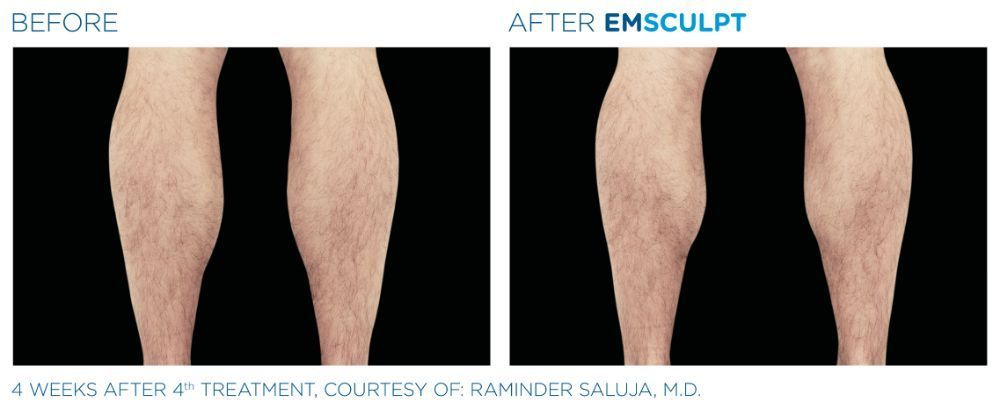 a picture of a man's legs before on the left and after Emsculpt treatment on the right