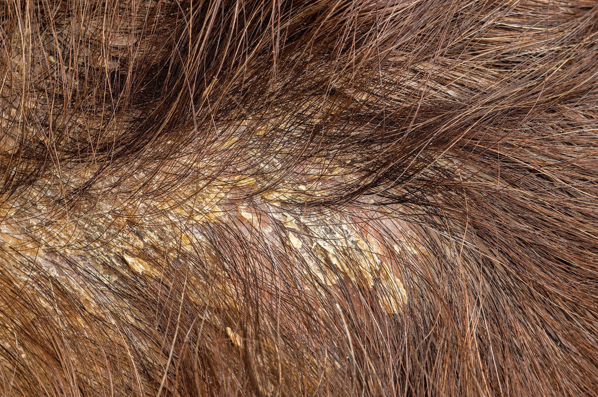 close up photo of Seborrhea on scalp