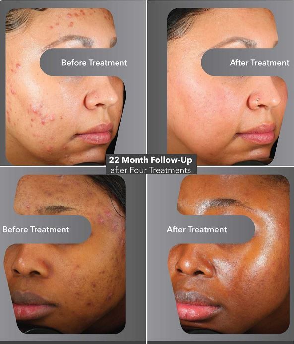 four pictures of a woman's face before and after treatment with accure laser