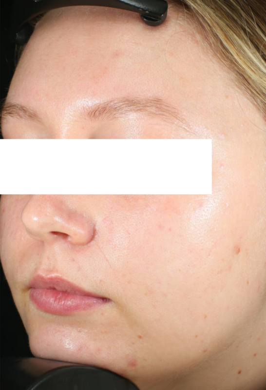 a close up of a woman's face facing down 3/4 left with her eyes covered, shown after accure acne laser treatments