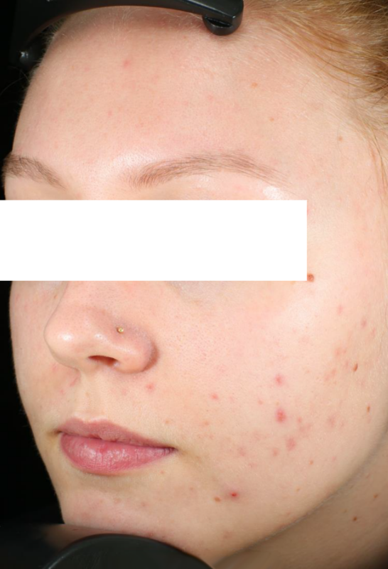 a close up of a woman's face facing down 3/4 left with her eyes covered, shown before accure acne laser treatments