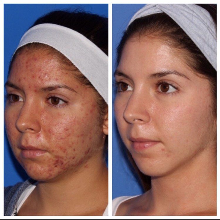 side by side before and after photo of woman's face with severe acne