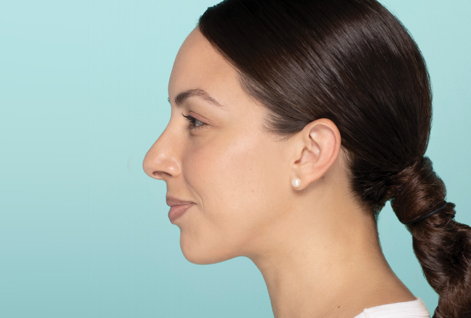 a profile of a girl facing left after dermal fillers. submental fat is reduced