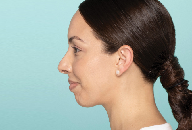 a profile of a girl facing left before dermal fillers
