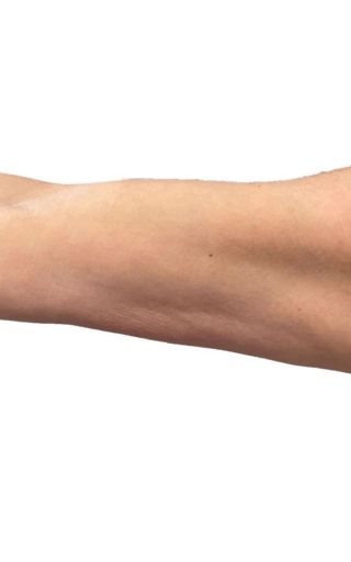 a close up of a woman's arm on a white background after skin tightening treatment