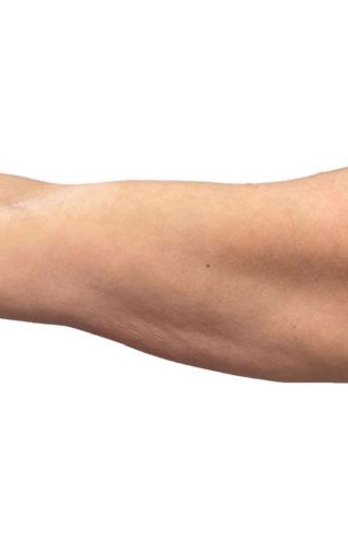 a close up of a woman's bicep with excess fat