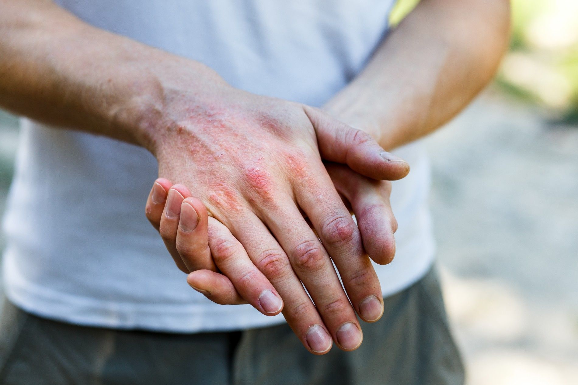 a man with a rash on his hands is holding his hands together