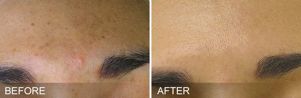 closeup of acne and discoloration on woman's forehead before and after treatment with Hydrafacial