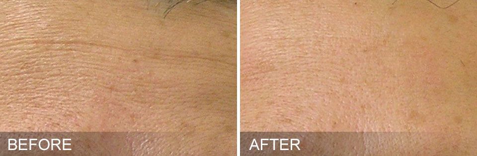 closeup of woman's facial wrinkles before and after treatment with Hydrafacial