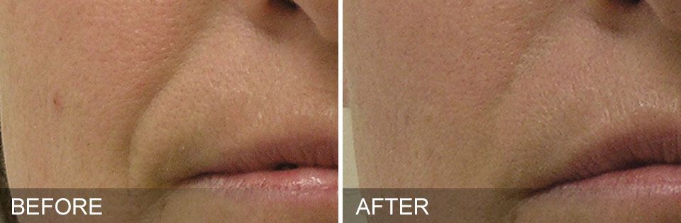 closeup of woman's nasolobial folds before and after treatment with Hydrafacial