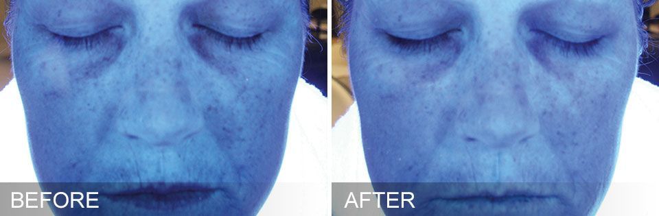 woman's face under blue light showing sun damage before and after treatment with Hydrafacial