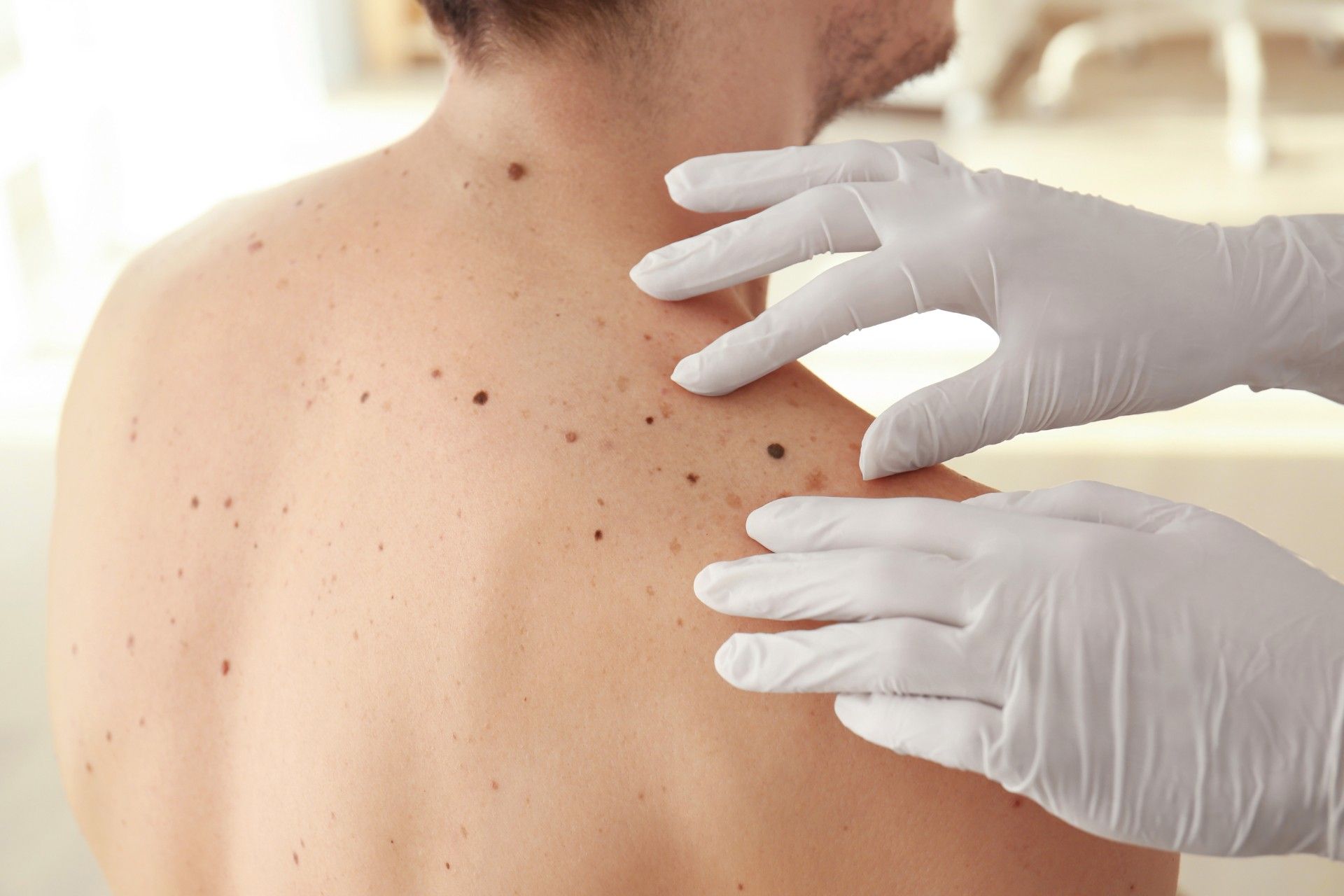 close up shot of a mole on a patient's back shoulder being examined by a hand wearing a gloves