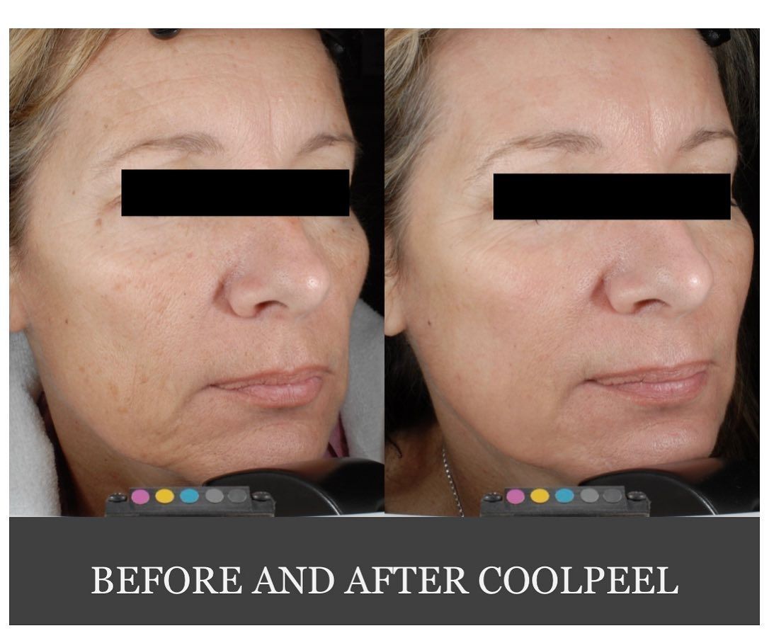 a before and after photo of a woman facing right with both her eyes covered by a black strip. before photo on the left shows visible skin pigmentation on the cheek and right photo shows her skin glowing after getting laser resurfacing treatment 