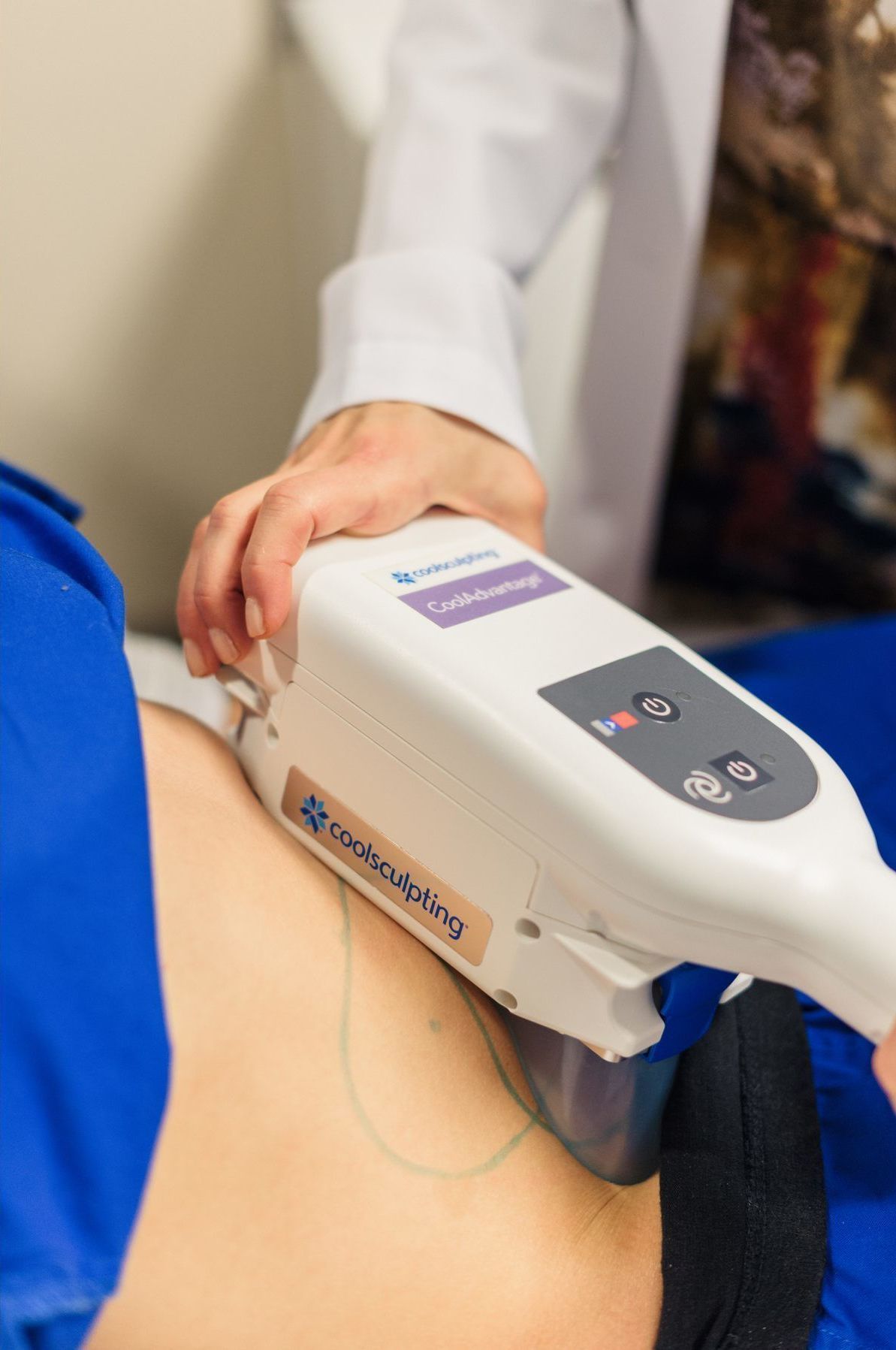closeup of the coolsculpting machine being applied to a patient's abdomen in treatment