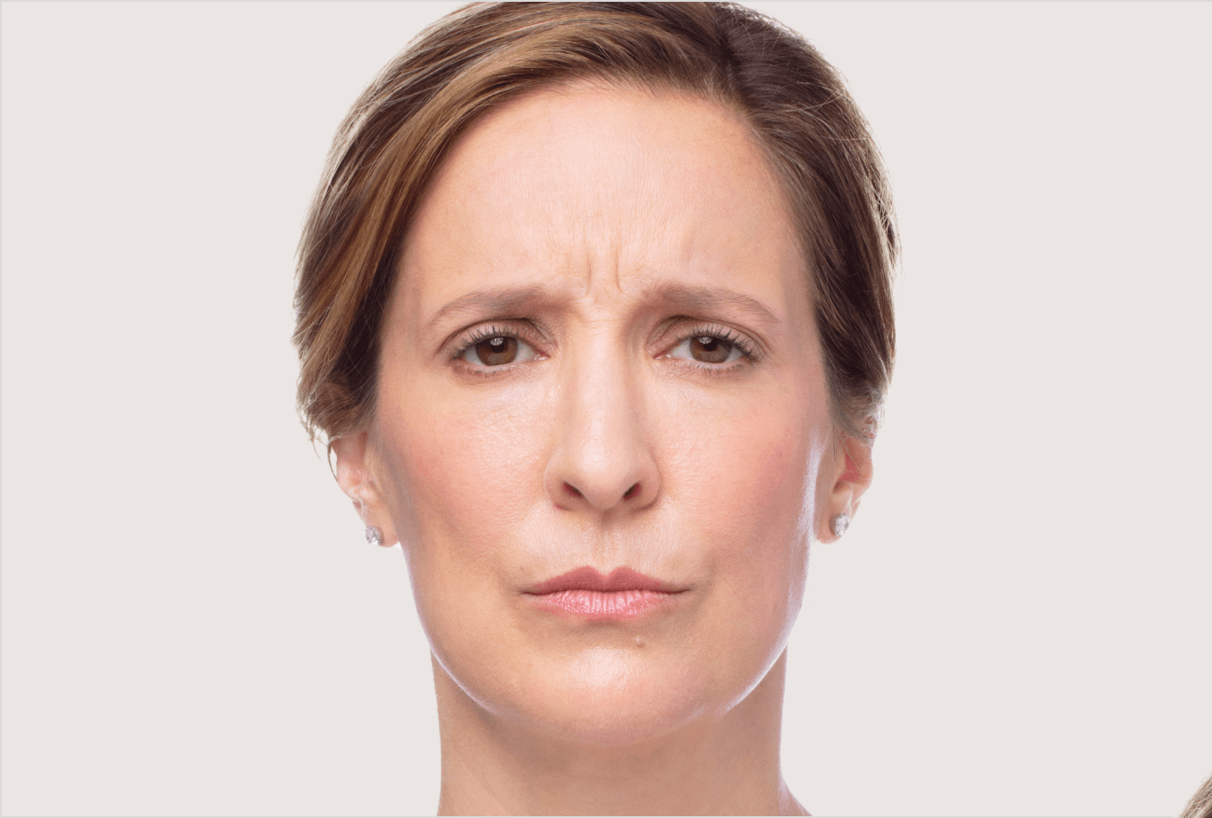 a woman is frowning showing the wrinkles on her forehead, facing front before Dysport treatment