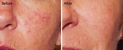 left photo shows a close up photo of a womans cheek showing visible small red veins and right photo showing results after getting the laser resurfacing treatment. small red veins are now gone.