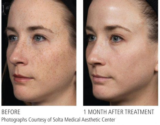 a before and after portrait of a woman's facing left after getting laser resurfacing treatment. her face is now smoother and has less wrinkles and glowing