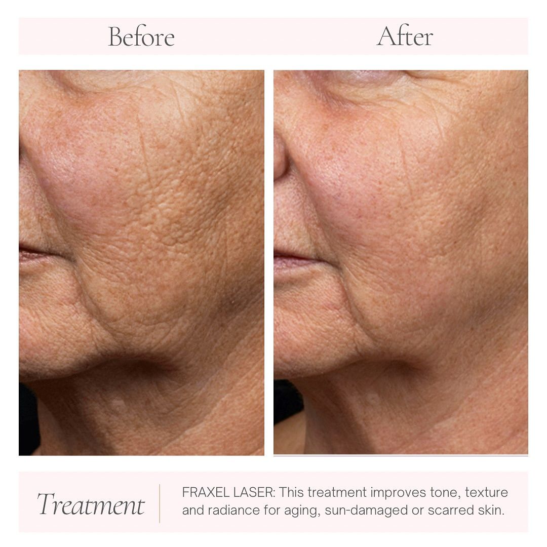a close up before and after photo of someones left cheek. after getting laser resurfacing treatment. her face is now smoother and has less wrinkles and glowing