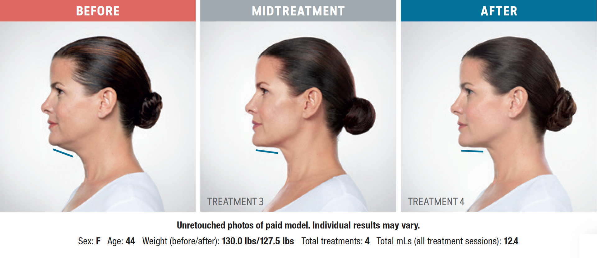 a woman's face is shown before and after treatment with Kybella double chin injectable