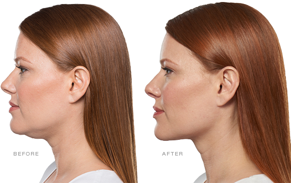 a before and after picture of a woman's face after treatment with Kybella double chin injectable