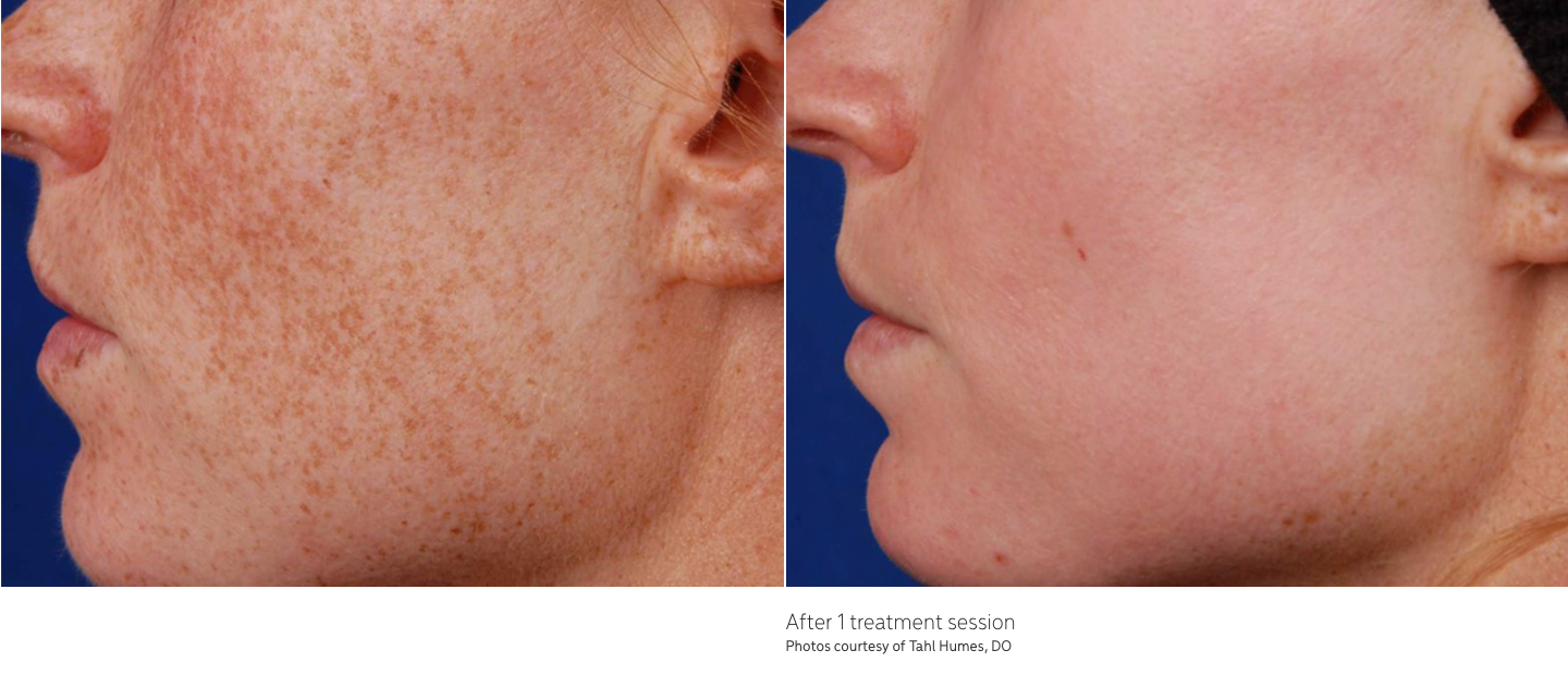 left photo shows a close up photo of a womans cheek showing visible small red spots and right photo showing results after getting the laser resurfacing treatment. small spots are now gone.