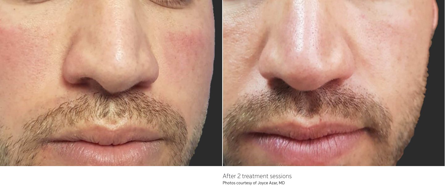 left photo shows a close up photo of a man's cheeks showing uneven skin color and right photo showing results after getting the laser resurfacing treatment. his skin is now even.