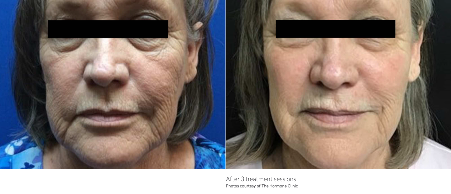 a before and after photo of a woman's entire face with both her eyes covered by a black strip. Her face is now smoother and has less wrinkles and glowing after getting laser resurfacing treatment. 