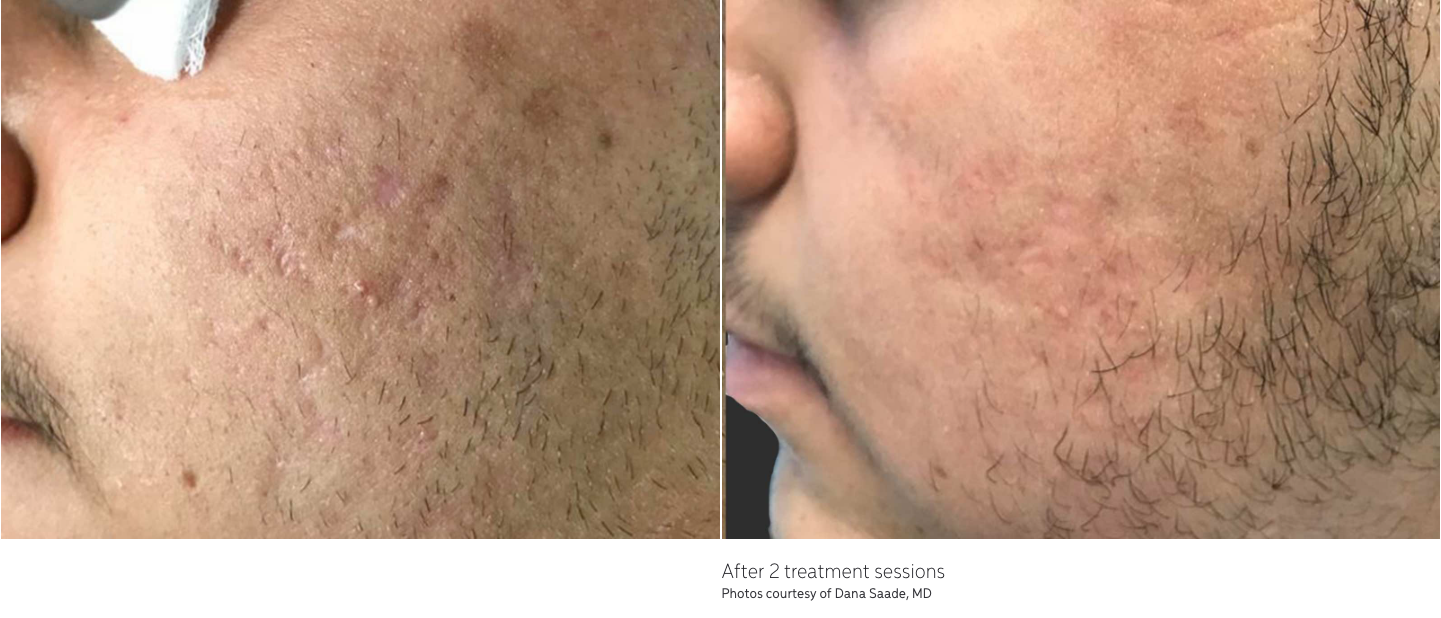 left photo shows a close up photo of a man's cheeks showing severe acne scars and pigmentation and right photo showing results after getting the laser resurfacing treatment. skin pigmentation is now gone.