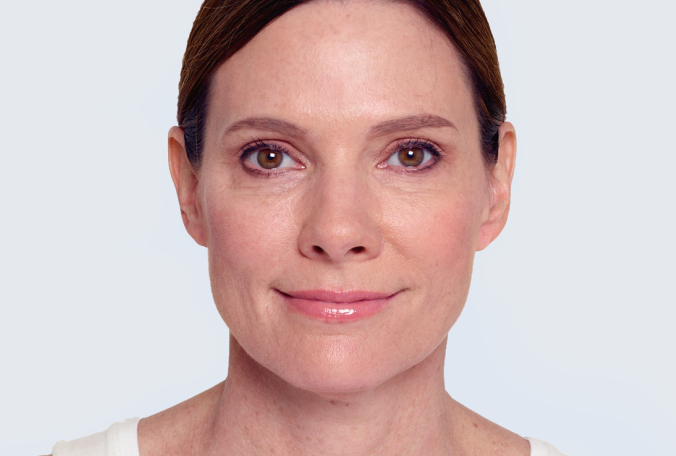 a close up of a woman 's face with a smile on her face after dermal fillers. face is now more defined and lifted.