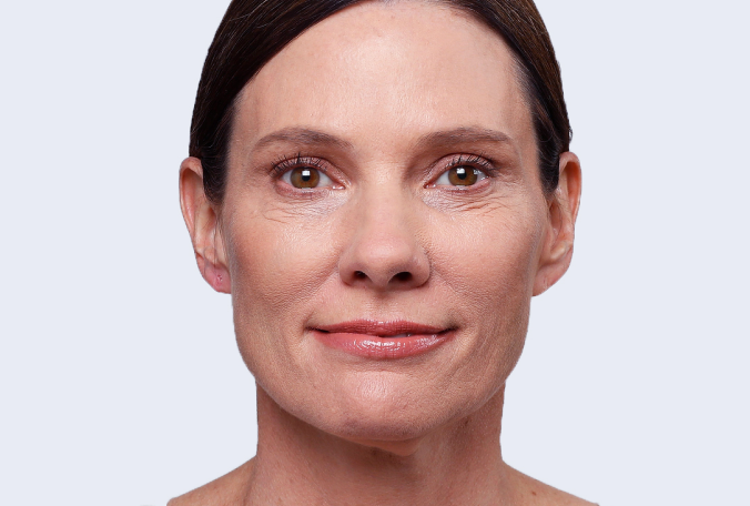 a close up of a woman 's face with a smile on her face before demal fillers