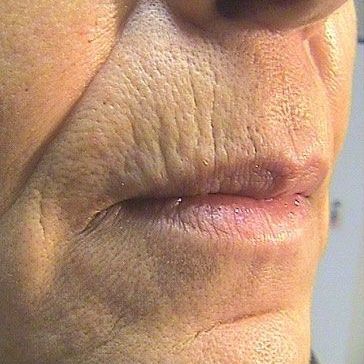 a before close up photo of an older woman 's lips. wrinkles, lines and sagging are visible