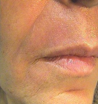 an after  close up photo of an older woman's lips. wrinkles, lines and sagging are no longer visible.