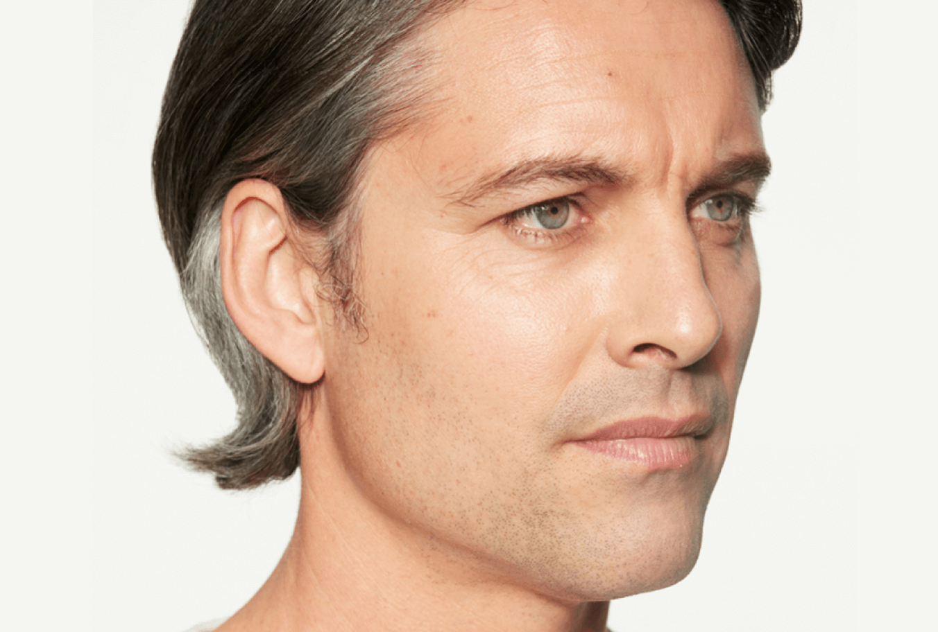 a close up of a man 's face with a serious look on his face after Sculptra treatment