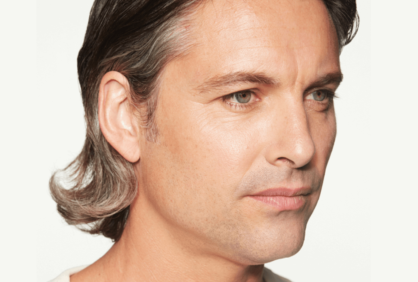 a close up of a man's face on a white background before Sculptra treatment