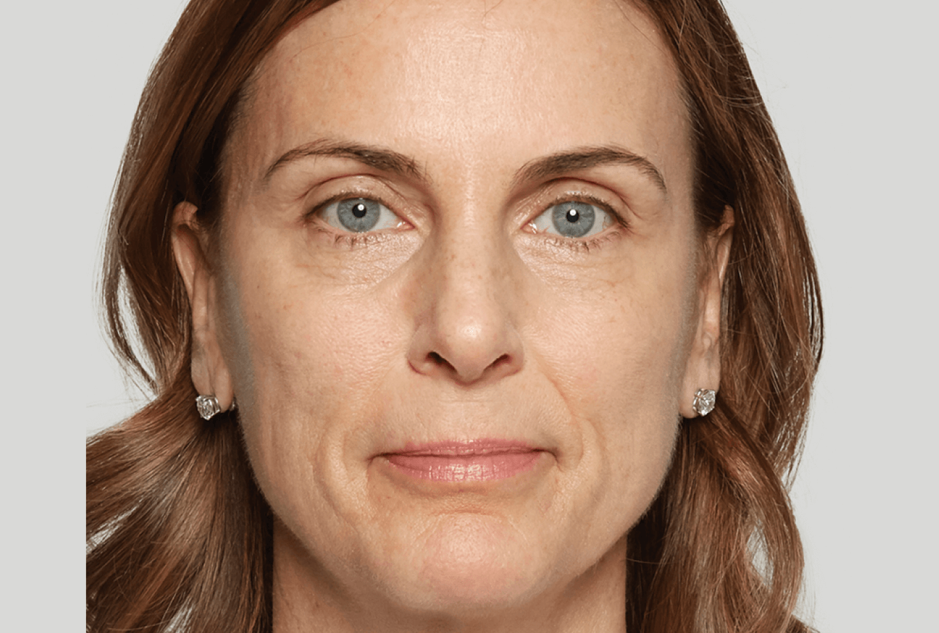 a close up of a woman 's face without makeup after Sculptra treatment