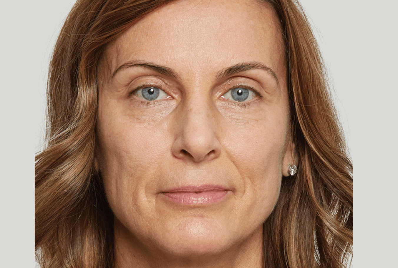 a close up of a woman 's face without makeup before Sculptra treatment
