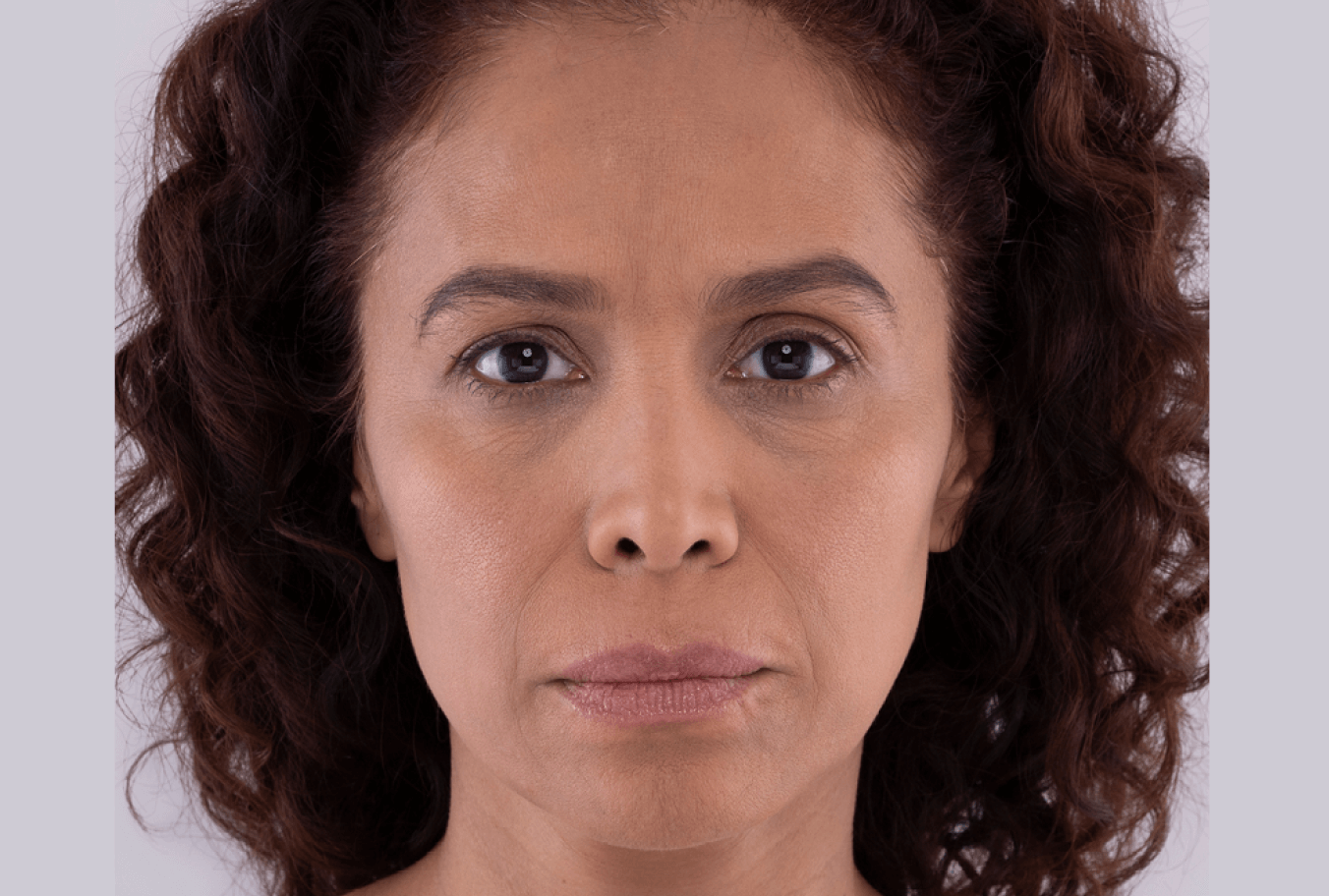 a woman with curly hair is looking at the camera with a serious look on her face after Sculptra treatment