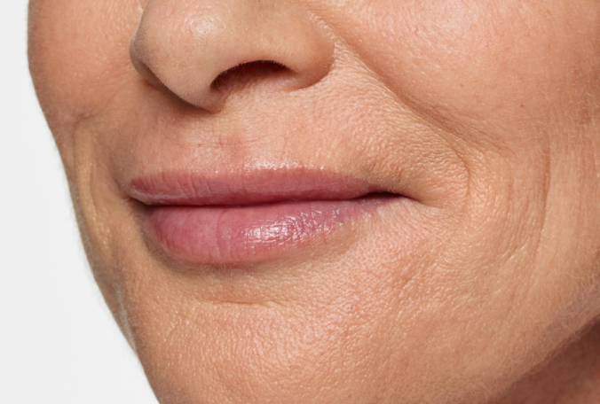 a close up shot of a woman 's bottom half  face with wrinkles on her lips after demal fillers